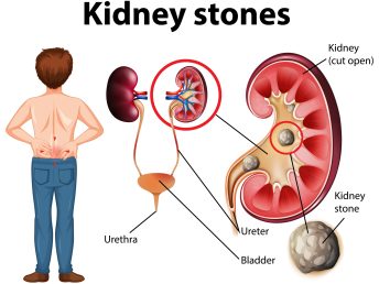 Comparison of healthy kidney and kidney with stones illustration