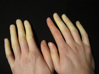 Raynauds-Syndrome
