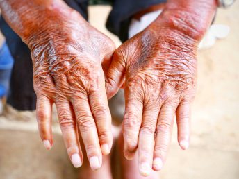 Scleroderma is an autoimmune condition that attacks the skin tissue.
Numstocker/Shutterstock